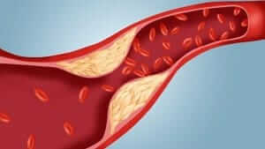 High blood cholesterol